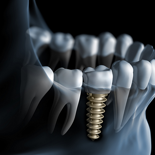 Illustrated x-ray of a person with a dental implant
