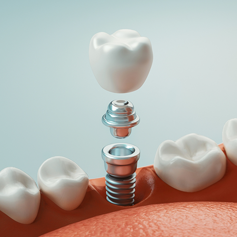 Illustration of a dental implant replacing a missing tooth