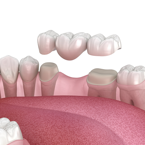 Illustrated dental bridge replacing a missing tooth