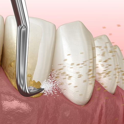 Illustration of a scaler clearing tartar from the teeth and gums