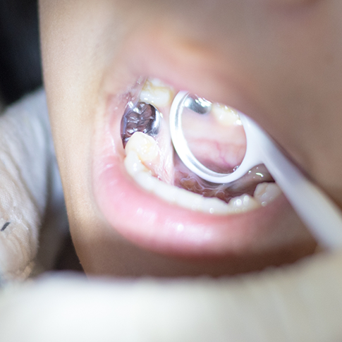 Close up of a dental mirror in a mouth with metal crowns over some teeth