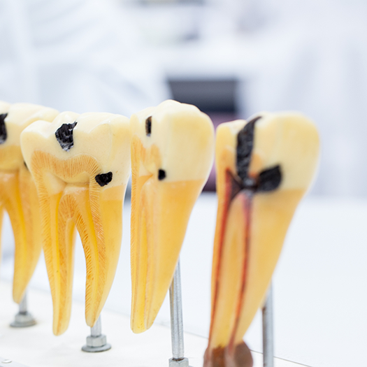 Models of decayed teeth