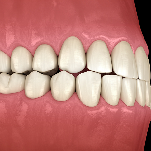Illustrated mouth with misaligned teeth