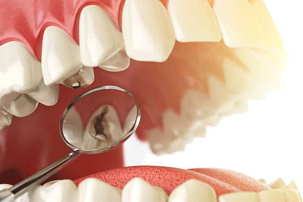 What Are Cavities And How To Prevent Them West Maitland Dentistry 