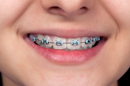 My Last Braces Checkup - Bending orthodontic wire - Tooth Time