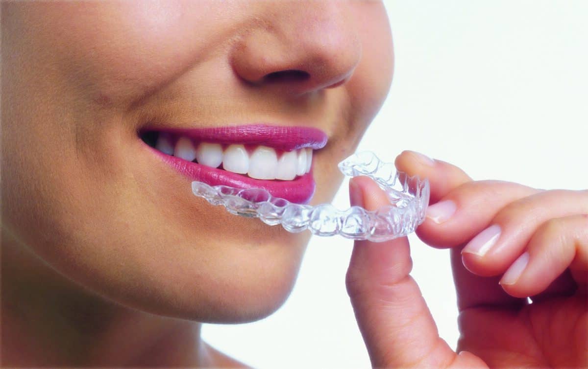 Are Invisible Braces Worth It? How They Work?